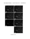 METHODS FOR THE DIAGNOSIS OR PROGNOSIS OF BREAST CANCER diagram and image