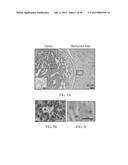 METHOD FOR TREATING CELL PROLIFERATIVE DISORDER BY INHIBITING C1GALT1     EXPRESSION diagram and image