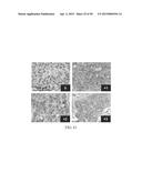 METHOD FOR TREATING CELL PROLIFERATIVE DISORDER BY INHIBITING C1GALT1     EXPRESSION diagram and image