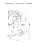 SURGICAL SYSTEM FOR AND A METHOD OF DISSECTION OF TISSUE AWAY FROM AN     ORGAN OR BODY LUMEN diagram and image