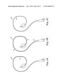 SURGICAL SYSTEM FOR AND A METHOD OF DISSECTION OF TISSUE AWAY FROM AN     ORGAN OR BODY LUMEN diagram and image