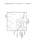 SURGICAL SYSTEM FOR AND A METHOD OF DISSECTION OF TISSUE AWAY FROM AN     ORGAN OR BODY LUMEN diagram and image