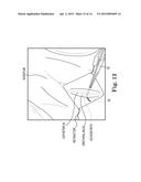 SURGICAL SYSTEM FOR AND A METHOD OF DISSECTION OF TISSUE AWAY FROM AN     ORGAN OR BODY LUMEN diagram and image