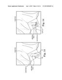 SURGICAL SYSTEM FOR AND A METHOD OF DISSECTION OF TISSUE AWAY FROM AN     ORGAN OR BODY LUMEN diagram and image