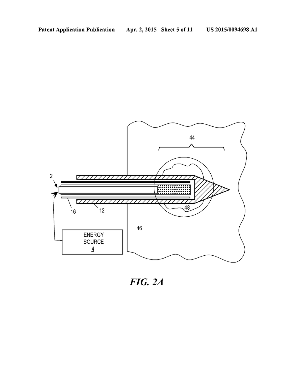 Cooled Laser Fiber for Improved Thermal Therapy - diagram, schematic, and image 06