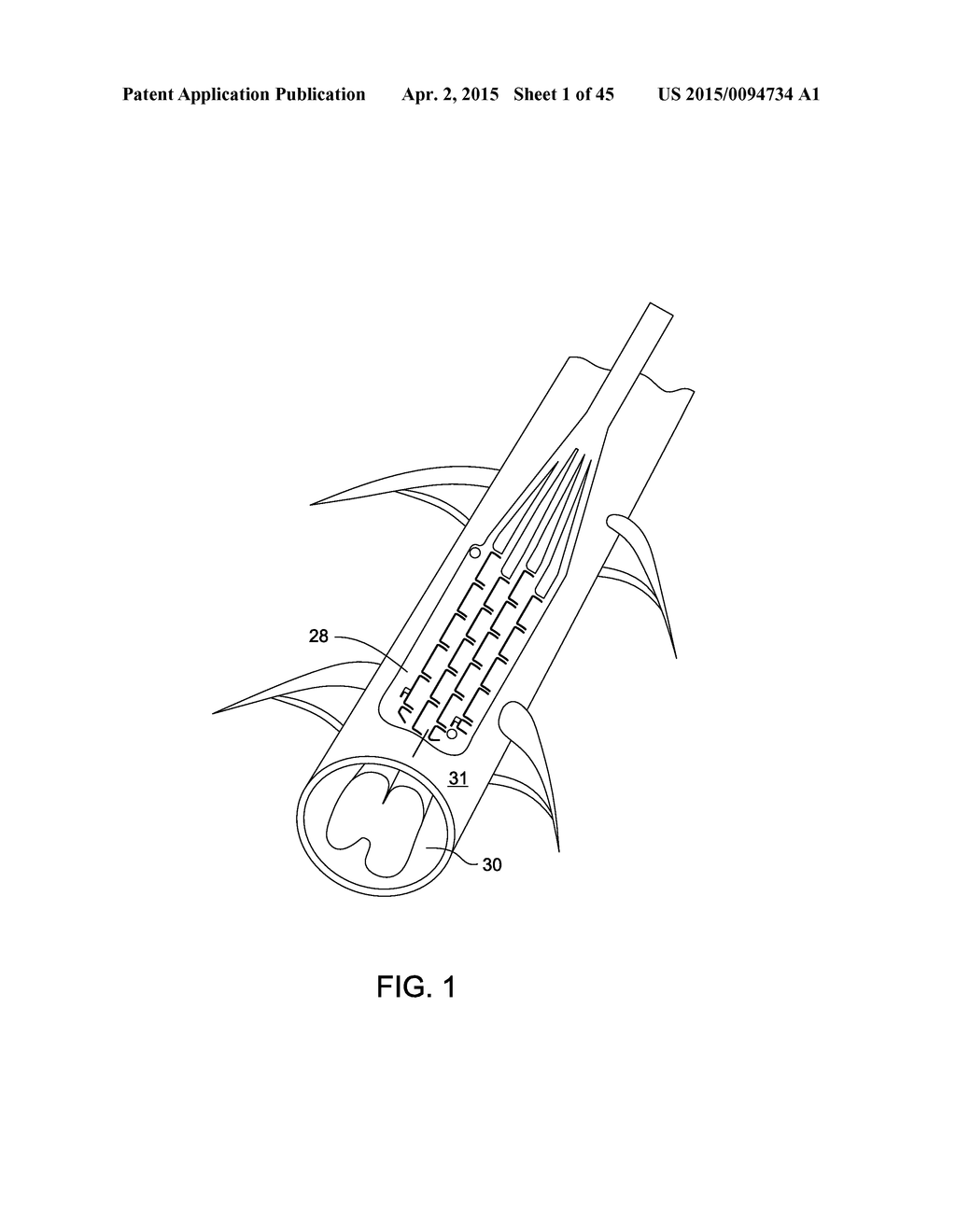 ELECTRODE ARRAY AND DEPLOYMENT ASSEMBLY INCLUDING AN ELECTRODE ARRAY THAT     IS FOLDED INTO A CANNULA THAT IS NARROWER IN WIDTH THAN THE ARRAY - diagram, schematic, and image 02