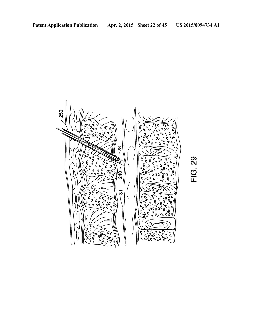 ELECTRODE ARRAY AND DEPLOYMENT ASSEMBLY INCLUDING AN ELECTRODE ARRAY THAT     IS FOLDED INTO A CANNULA THAT IS NARROWER IN WIDTH THAN THE ARRAY - diagram, schematic, and image 23