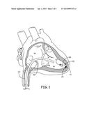 TOOLS AND ASSEMBLIES THEREOF FOR IMPLANTABLE MEDICAL DEVICES diagram and image