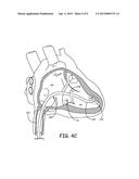 TOOLS AND ASSEMBLIES THEREOF FOR IMPLANTABLE MEDICAL DEVICES diagram and image