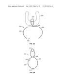 VASCULAR ANASTOMOSIS STENT diagram and image