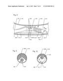 THROMBECTOMY AND SOFT DEBRIS REMOVAL DEVICE diagram and image