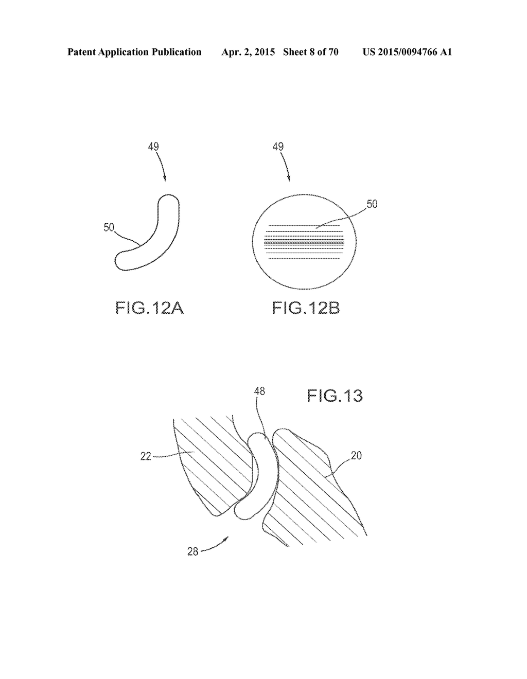 DEVICE AND METHOD FOR REINFORCEMENT OF A FACET - diagram, schematic, and image 09