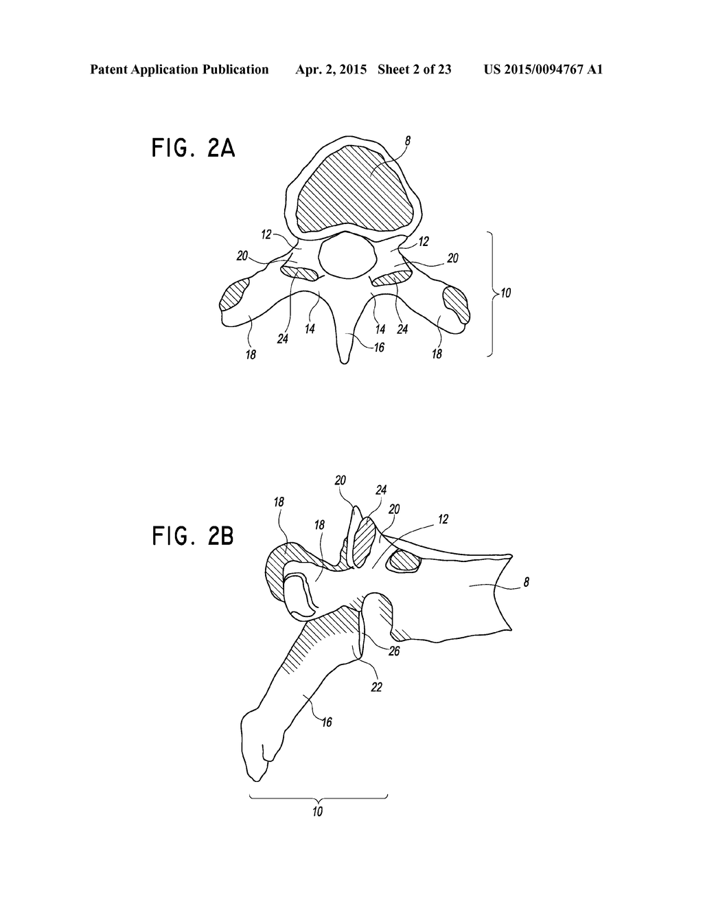 METHOD OF PLACING AN IMPLANT BETWEEN BONE PORTIONS - diagram, schematic, and image 03