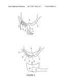 METHOD, SYSTEM AND USE FOR THERAPEUTIC ULTRASOUND diagram and image