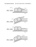 NEGATIVE PRESSURE WOUND THERAPY APPARATUS diagram and image