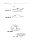 NEGATIVE PRESSURE WOUND THERAPY APPARATUS diagram and image