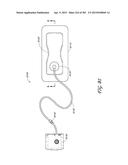 NEGATIVE PRESSURE WOUND THERAPY APPARATUS diagram and image