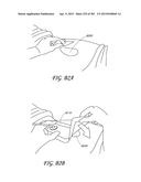 NEGATIVE PRESSURE WOUND THERAPY APPARATUS diagram and image