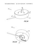 NEGATIVE PRESSURE WOUND THERAPY APPARATUS diagram and image