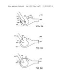 PLACING SUTURES diagram and image