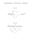 SURGICALLY CLOSING PERCUTANEOUSLY PUNCTURES diagram and image