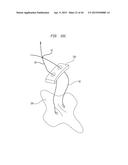 SURGICALLY CLOSING PERCUTANEOUSLY PUNCTURES diagram and image