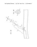 SURGICALLY CLOSING PERCUTANEOUSLY PUNCTURES diagram and image