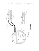 Implantable Medical Device with One or More Magnetic Field Sensors to     Assist with External Charger Alignment diagram and image