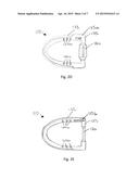 Systems, Devices, and Methods for Retaining Oral Devices for Airway     Treatment diagram and image