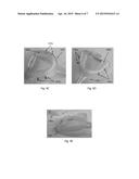 Systems, Devices, and Methods for Retaining Oral Devices for Airway     Treatment diagram and image