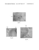 Systems, Devices, and Methods for Retaining Oral Devices for Airway     Treatment diagram and image