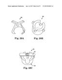 SYSTEMS, IMPLANTS, TOOLS, AND METHODS FOR TREATMENTS OF PELVIC CONDITIONS diagram and image