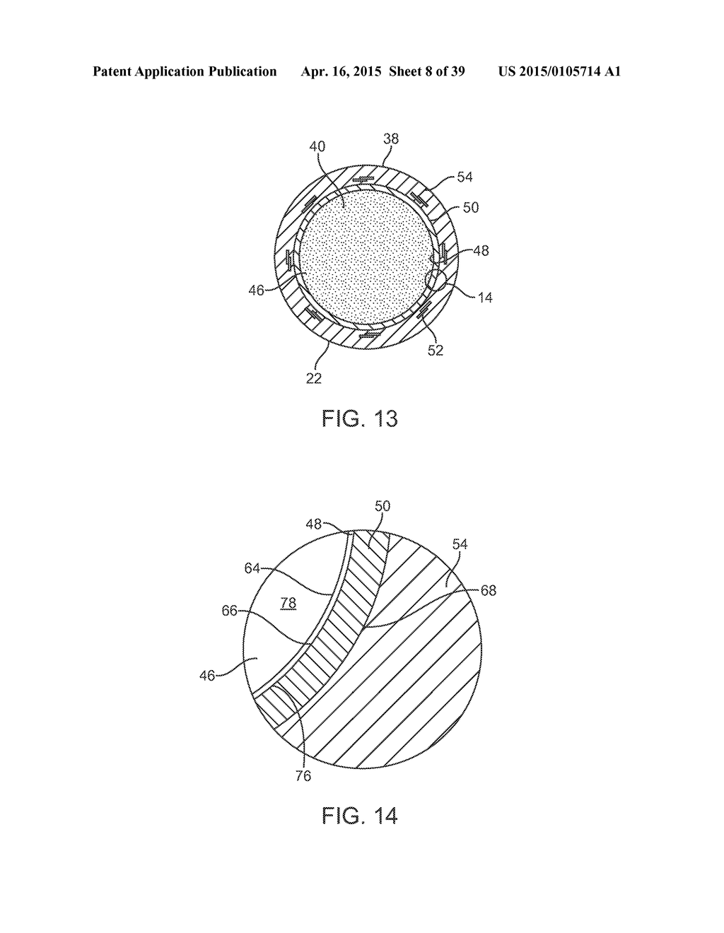 METHODS AND DEVICES FOR TREATMENT OF STENOSIS OF ARTERIOVENOUS FISTULA     SHUNTS - diagram, schematic, and image 09