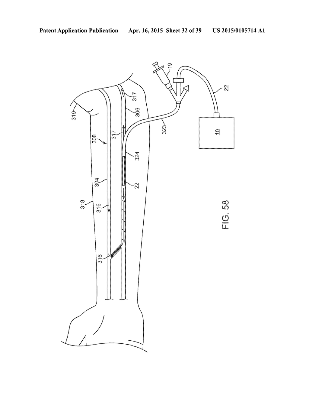 METHODS AND DEVICES FOR TREATMENT OF STENOSIS OF ARTERIOVENOUS FISTULA     SHUNTS - diagram, schematic, and image 33