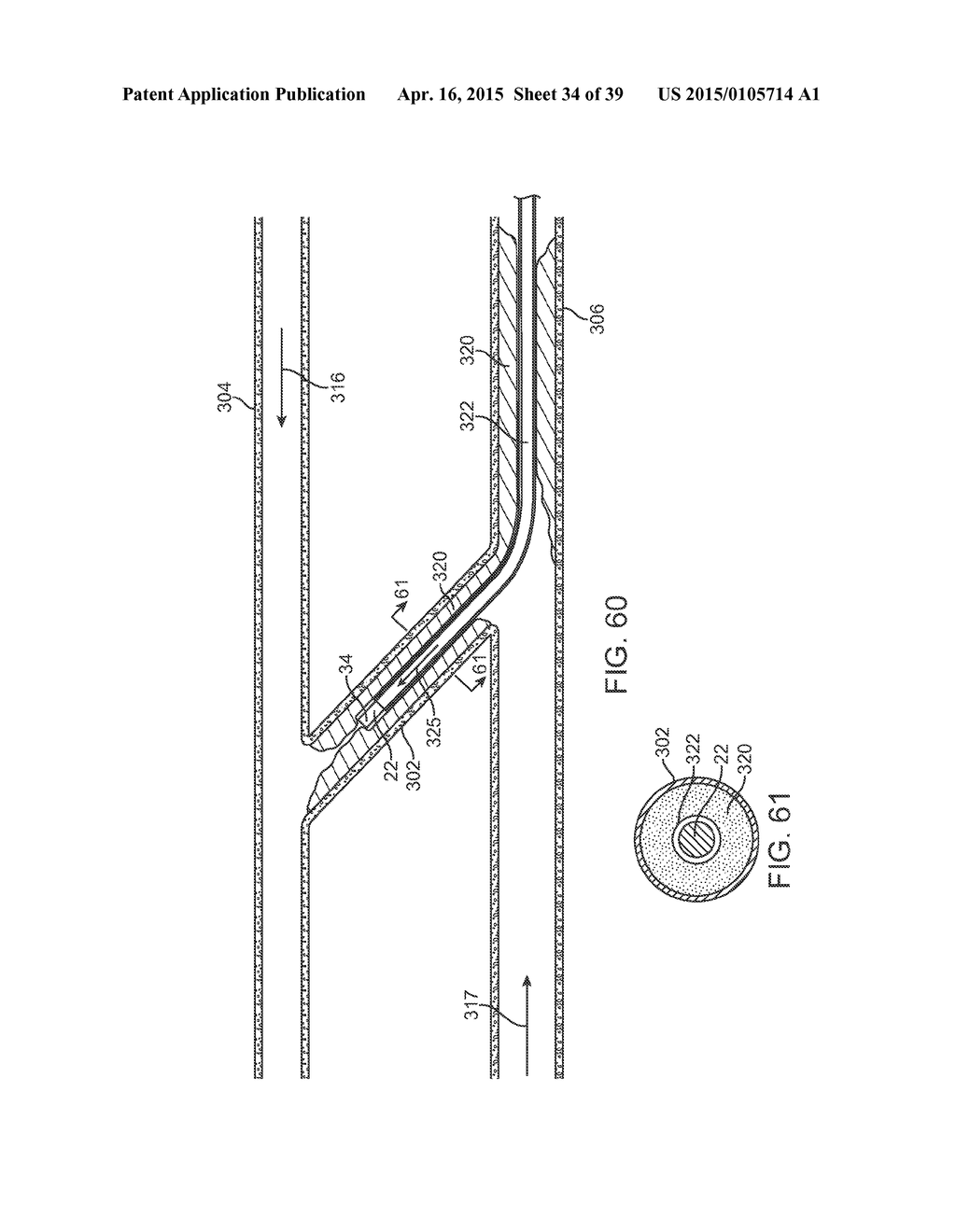 METHODS AND DEVICES FOR TREATMENT OF STENOSIS OF ARTERIOVENOUS FISTULA     SHUNTS - diagram, schematic, and image 35