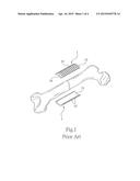 BONE FIXATION PLATE diagram and image