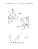 DEVICE FOR USE IN FACILITATING ALIGNMENT OF AN ACETABULAR COMPONENT diagram and image