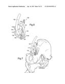 DEVICE FOR USE IN FACILITATING ALIGNMENT OF AN ACETABULAR COMPONENT diagram and image