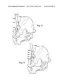 DEVICE FOR USE IN FACILITATING ALIGNMENT OF AN ACETABULAR COMPONENT diagram and image