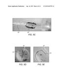 Deployable and Multi-Sectional Hearing Implant Electrode diagram and image