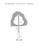 Deployable and Multi-Sectional Hearing Implant Electrode diagram and image