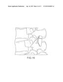 INTERSPINOUS SPACER DEVICES FOR DYNAMIC STABILIZATION OF DEGRADED SPINAL     SEGMENTS diagram and image