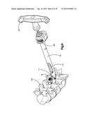 TIGHTENING DEVICE FOR SPINE SURGERY diagram and image