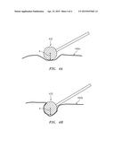 Methods of Using Multilayer Medical Sponges diagram and image