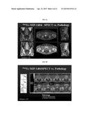 METHODS OF USING SPECT/CT ANALYSIS FOR STAGING CANCER diagram and image