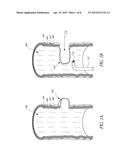 DIVERTICULUM TREATING DEVICE diagram and image