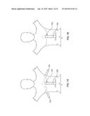 DIAPHRAGM ENTRY FOR POSTERIOR SURGICAL ACCESS diagram and image