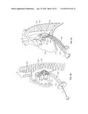 DIAPHRAGM ENTRY FOR POSTERIOR SURGICAL ACCESS diagram and image