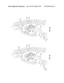 DIAPHRAGM ENTRY FOR POSTERIOR SURGICAL ACCESS diagram and image