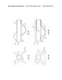 DIAPHRAGM ENTRY FOR POSTERIOR SURGICAL ACCESS diagram and image